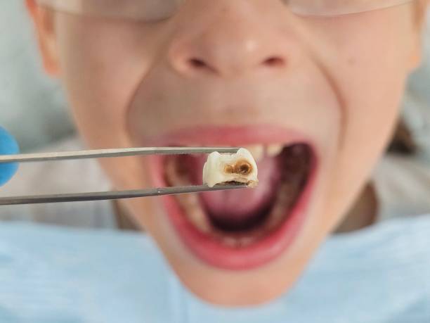Best Emergency Treatment for Toothache in Barnwell, SC